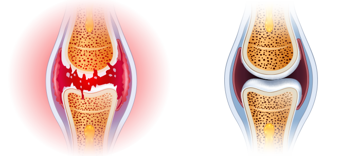 5 presudno činjenice vezi reumatidnog artritisa